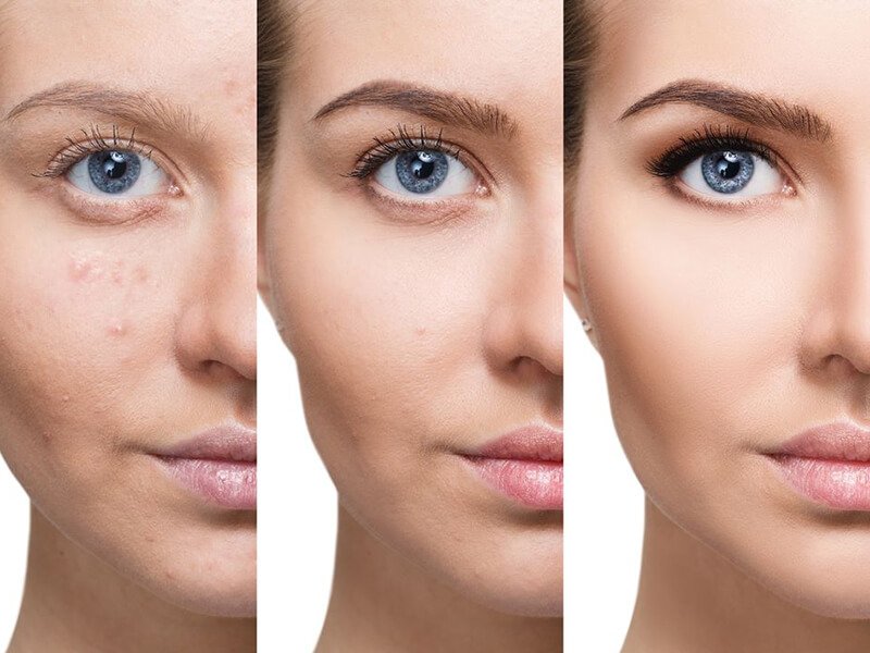 Skin Booster (Skin Bio-Remodeling) – Divine Aesthetics & Laser Clinic